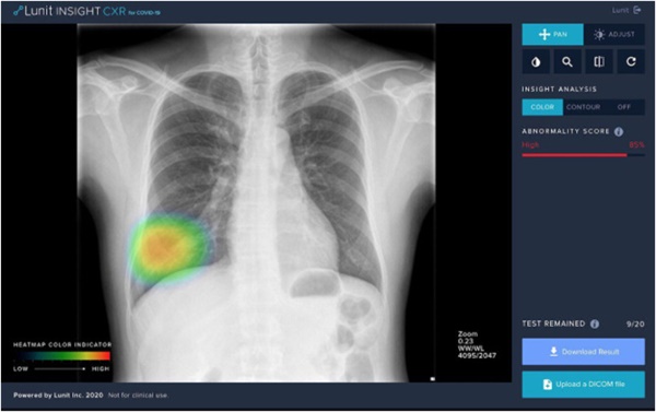     흉부 X-Ray 영상 속 코로나19 감염 폐렴 판독 화면