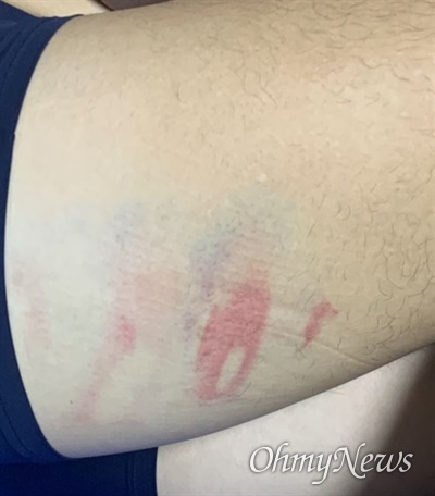  A교수에게 허벅지를 폭행 당한 학생을 찍은 사진. 