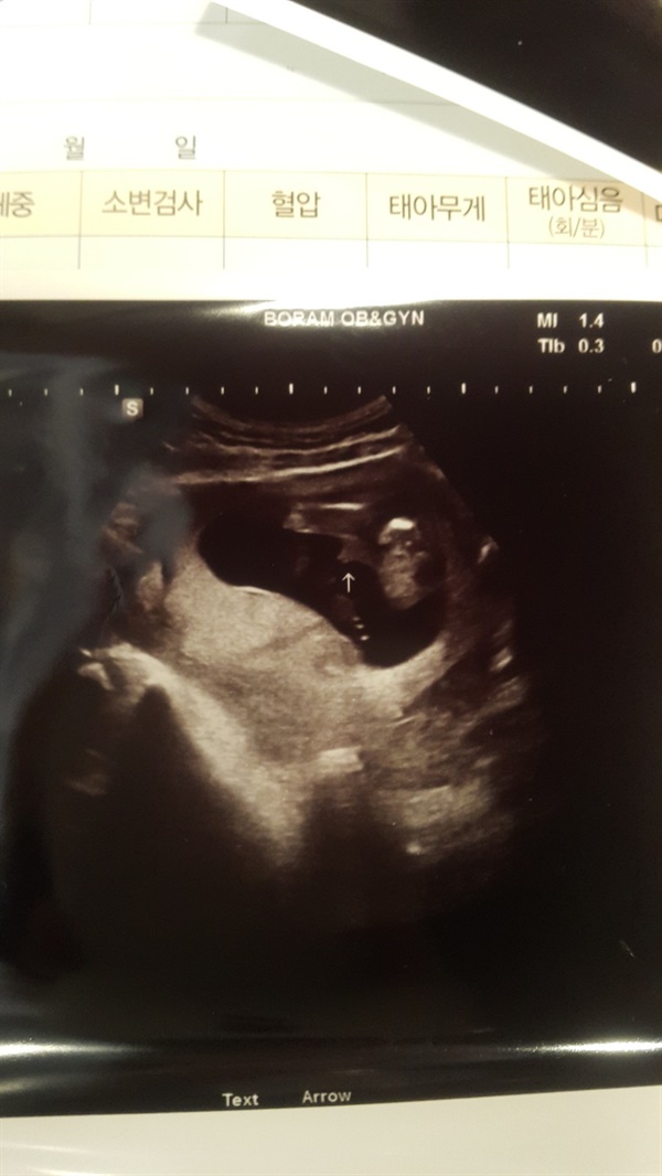 아기의 검진 시에 촬영한 초음파 사진