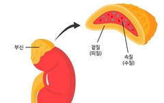 생소한 부신질환, 수술 방법과 시기는?