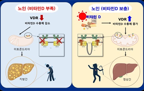 비타민 D, 자연노화로 인한 '노인성 지방간 생성' 억제한다