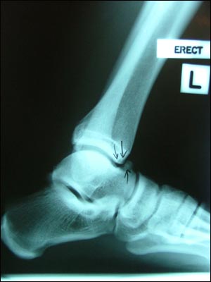 발 주위 X-ray사진. 발목이 존재하는지에 대한 법정 소송이 벌어지고 있는 미국에서는 이 사진을 단순히 '발목 사진'이라고 할 수 없다.