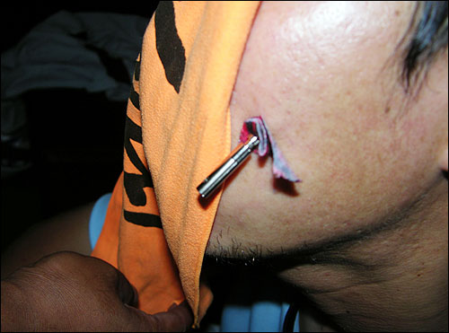 쌍용차노조 조합원이 2009년 7월 22일 경찰과 충돌 과정에서 경찰이 쏜 테이저건에 얼굴을 맞은 모습. 경찰은 국제사면위원회도 사용 금지한 테이저건을 꺼내들었다. 