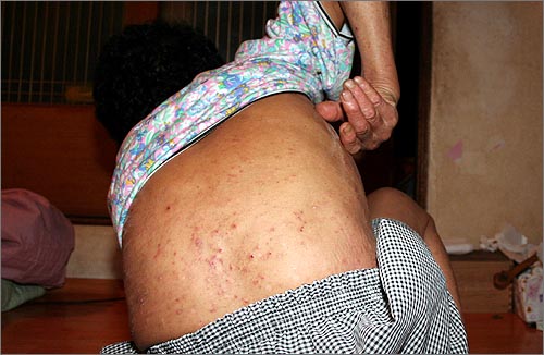 지난 2006년 전남 광양시 태인동 주민들이 원인을 알 수 없는 피부 질환 등을 호소했다. 이 당시 한 주민은 등, 다리, 손, 가슴과 배 등 피부가 빨갛게 도드라졌고, 가려움증상이 있었다. 
