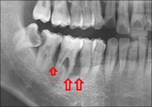 치주 질환에 이환된 환자의 방사선 사진(붉은 화살표 부분). 치료 되지 않은 잇몸병은 잇몸뼈를 조금씩 흡수하다가 결국 치아를 상실하게 만드는 중요한 원인으로 작용한다. 해당 환자는 30대 중반의 젊은 나이였지만 치아의 동요도가 심해서 어쩔 수 없이 2개의 치아를 발치 후 임플란트를 시행했다.