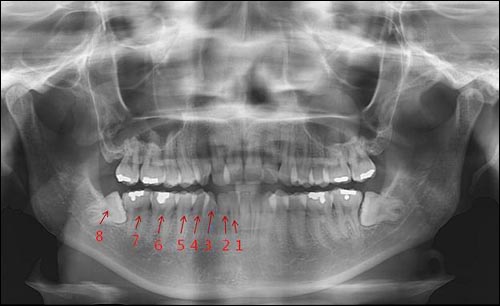 치과의사들은 치아에 숫자를 붙인다. 가장 뒤에 있는 사랑니의 치식은 8번 사랑니 바로 앞의 제2대구치가 7번이다. 인류가 생식을 하던 과거에는 사랑니가 똑바로 맹출하고 그 뒤로 9번 치아까지 존재했다.