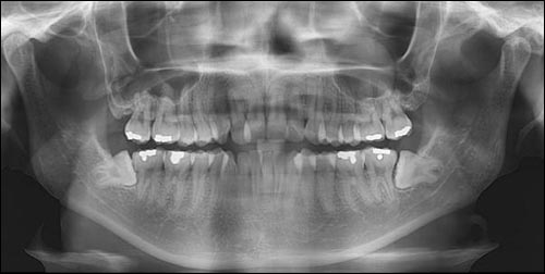 사랑니의 맹출력은 전치부까지 전달되지 않는다. 앞니가 삐뚤어지는 것은 치아가 몸의 중심쪽을 향해 이동하는 특징 때문이다. 같은 이유로 뒤쪽의 사랑니를 발거한다 하더라도 7번 치아가 뒤로 기울어지는 경우는 거의 없다.