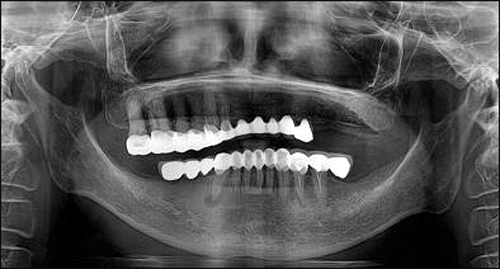 치과의사와 다르게 무자격자는 자신의 진료에 책임을 지지 않아도 되기 때문에 무리한 형태의 보철을 시행하는 경우가 많다. 해당 환자는 남은 치아 전부를 뽑고 틀니를 시행했다.
