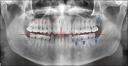 치과의사들은 치아에 번호를 붙여서 이야기 한다. 중절치- 1, 측절치- 2, 견치- 3, 제1소구치- 4, 제2소구치 -5, 제1대구치 -6, 제2대구치- 7.
