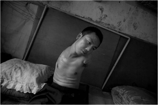 중국 탄광에서 노동을 하다 양팔이 절단된 청년노동자 류펑씨. 