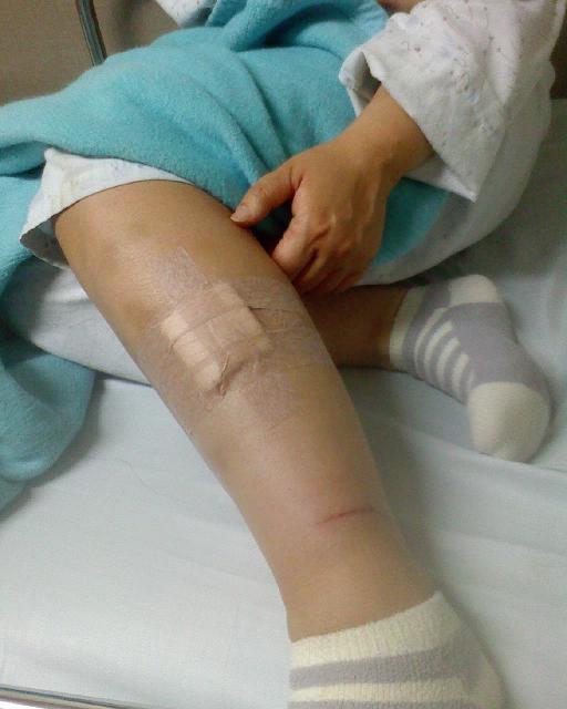 다리에 박힌 대못 때문에 봉합수술을 한 상처.
