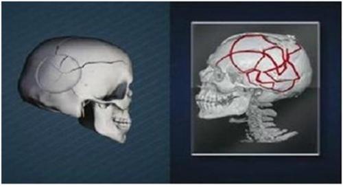 6cm 둥근 함몰 흔적이 발견된 장준하 두개골과 일반 추락사 시 발생하는 두개골의 형태차이.