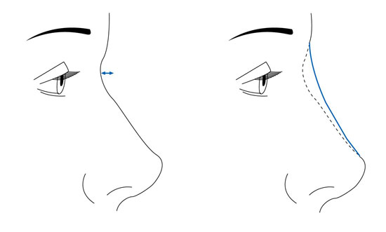 좌측은 일반적인 코의 모습, 우측은 코를 높이는 성형을 하면서 코뿌리부분이 위로 올라간 모습.