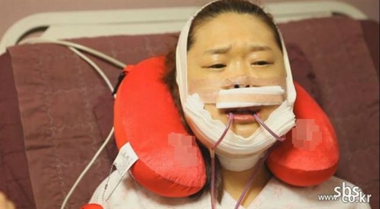 양악수술 열풍을 다룬 SBS 스페셜 '그녀, 뼈를 깎다'.