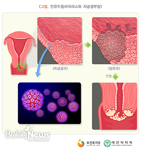  자궁은 체부(corpus)와 경부(cervix)로 구성되는데, 질에 연결된 자궁경부에 발생하는 악성종양을 자궁경부암이라고 한다.