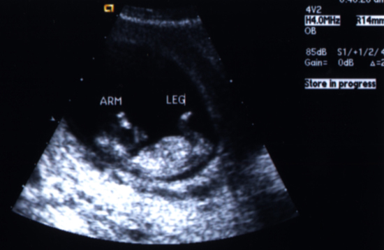 태아의 초음파 사진