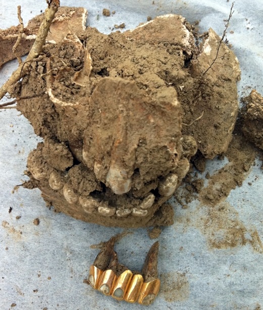 공주 왕촌 살구쟁이 골짜기 5구덩이에서 추가발굴된 희생자 유해. 이번 발굴에서 금도금 치아가 발굴됐다.  