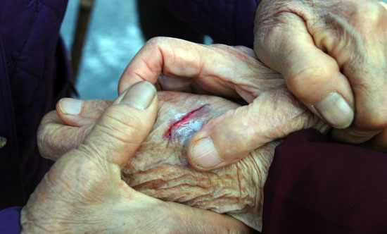최호금(85) 할머니의 손등이 날카로운 흉기에 베인  것처럼 깊숙이 찢어졌다. 
