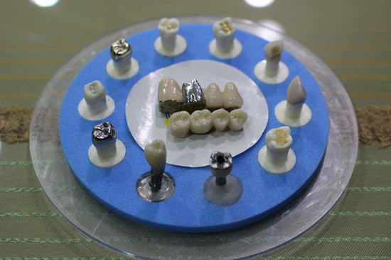 브릿지(사진 가운데)라는 것은 한두개의 치아 결손시에 전방과 후방의 치아를 삭제하여 씌우는 보철을 말한다. 보험에서 보장해주는 것은 결손된 치아에 한정된 것이지 전후방에 삭제하는 치아는 제외된다는 것을 알아야한다.