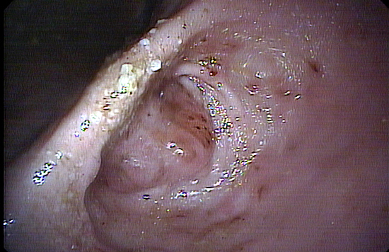 내시경으로 들려다 본 정체 불명의 덩어리. 뚫려 있어야 할 곳을 가로막고 있는 덩어리가 보입니다.