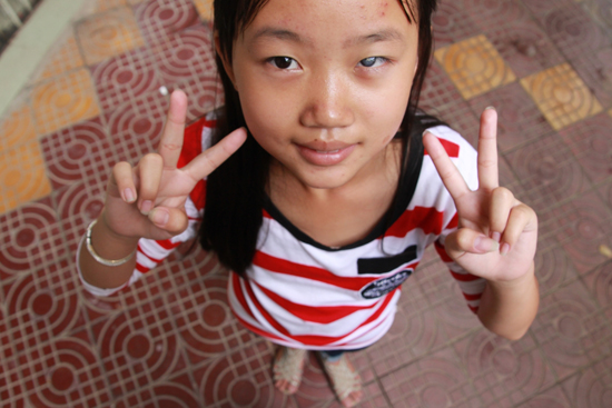 4년전 각막에 이상이 생겨 한쪽 눈을 잃을 뻔 했던 캄보디아 소녀 마일린(12)이 한국과 재미교포 후원자들의 도움으로 마침내 시력을 되찾았다(지난 8월 수술 전 모습).