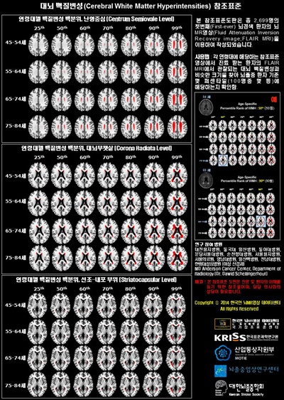  한국표준과학연구원이 국내 11개 대학병원과 함께 뇌경색 위험을 예측할 수 있는 표준자료 '한국인 허혈 뇌지도'를 완성했다. 만성적인 뇌혈류 순환장애 정도를 등급화한 허혈 뇌지도를 활용하면 자신의 만성 허혈성 뇌손상이 우리나라 뇌경색환자 기준 100명 중 몇 등인지 알 수 있다. 2014.12.29 <한국표준과학연구원>