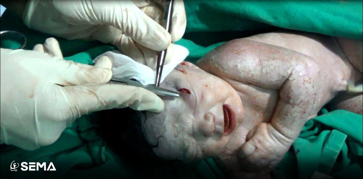 시리아에서 이마에 파편이 박힌 채 태어난 아기가 파편 제거 수술을 받고 있다.