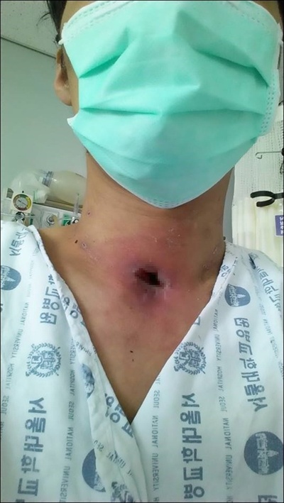 기관절개술을 한 흔적. 목에 작은 구멍을 만들고 그 구멍으로 관을 삽입하여 환자가 숨을 쉴 수 있게 해준다.