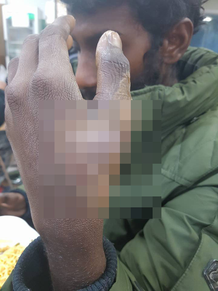 스리랑카 출신 이주노동자 깃남은 다친 손으로 보름 넘게 노동을 강요당했다. 