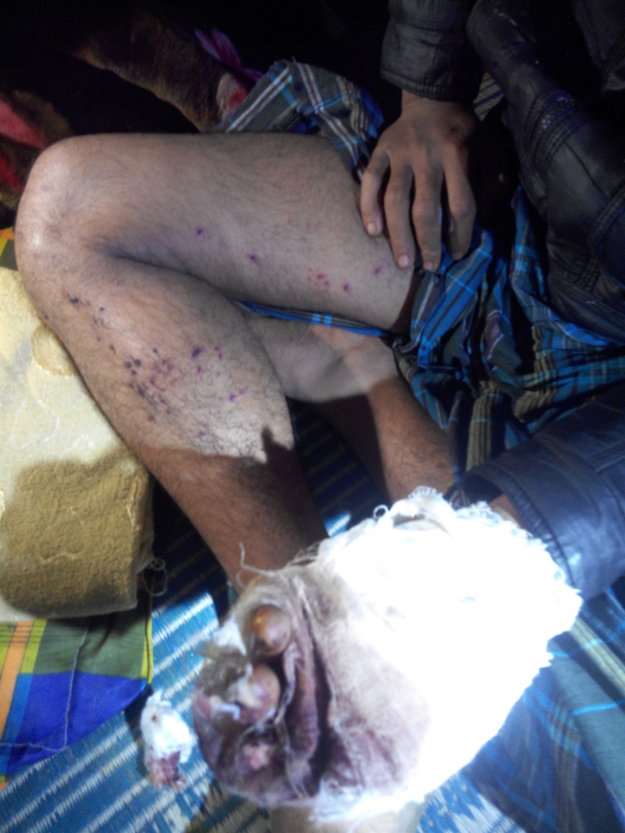 미얀마군의 로힝야족 토벌작전으로 인해 손가락 절단과 다리에 부상을 입은 로힝야 남성