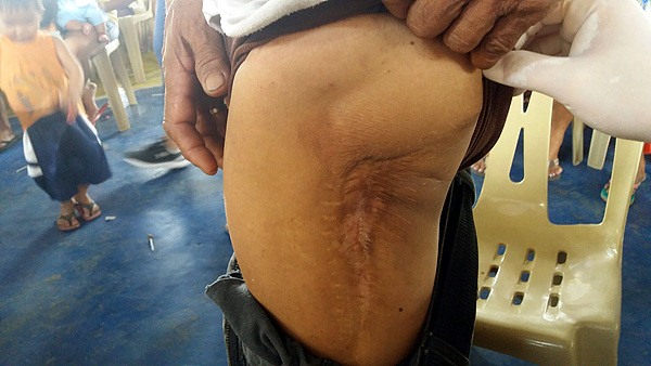 군시절(26살) 민다나오에서 반군과의 전투 중 총상을 입은 환자(53세)가 진료를 받으러 왔지만 심병수 원장은 약이 독하기 때문에 참는 게 낫다고 한다. 