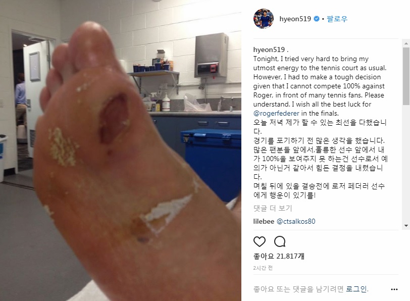  정현이 자신의 소셜미디어에 올린 발바닥 물집 부상 사진 갈무리.