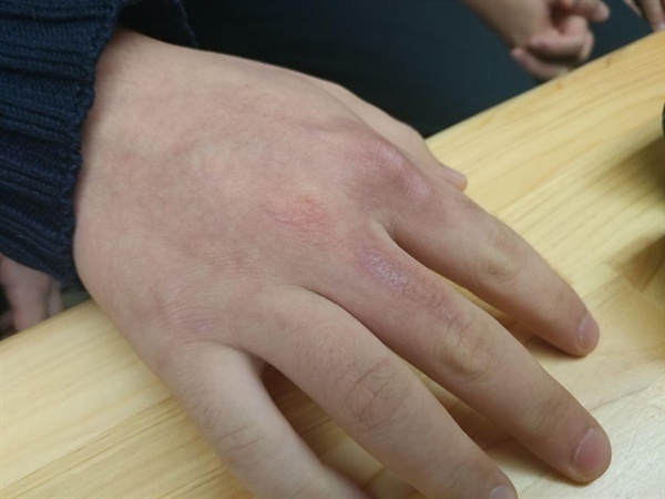 고등학생 A군은 2018년 5월 한진택배 대전물류센터에서 일하다 부상을 당했다. 사고 후 반년이 지났지만 여전히 손가락에 자국이 남아있다.