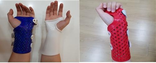 3D 프린팅으로 제작한 손목 보조기 (흰색은 임상에서 제작되는 손목보조기)