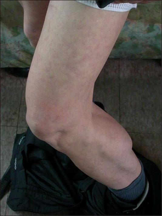 2004년 12월 20일 오마이뉴스 인터뷰에서 심진구씨는 고문과정에서 몽둥이로 허벅지를 집중적으로 가격당했으며 밟히기도 했다고 말했다. 허벅지가 붉은 색에 가까우며 핏줄이 서 있다.