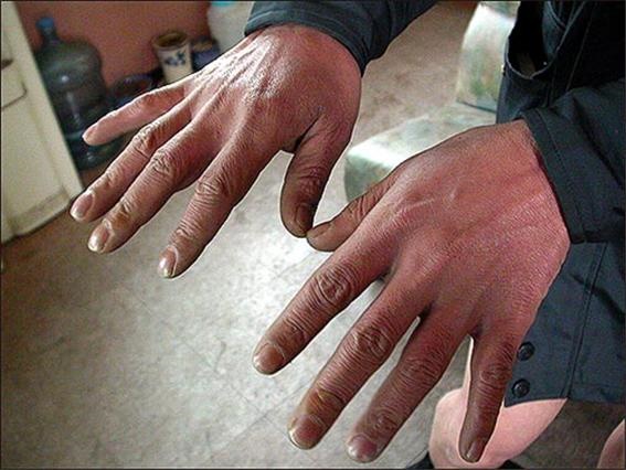 2004년 12월 20일 오마이뉴스와 인터뷰 할 때 심진구씨는 고문 후유증으로 혈액순환이 되지 않아 손이 심하게 붉고 가끔 손을 떨기도 했다. 심씨가 손을 보여주고 있다.