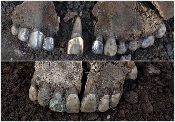 대전 골령골 민간인 집단희생지 유해발굴 현장에서 발굴된 희생자의 치아. 금니와 은니를 한 치아(사진 위),  고급 치과 치료를 한 흔적이 뚜렷한 치아(사진 아래)가 각각 발굴됐다.