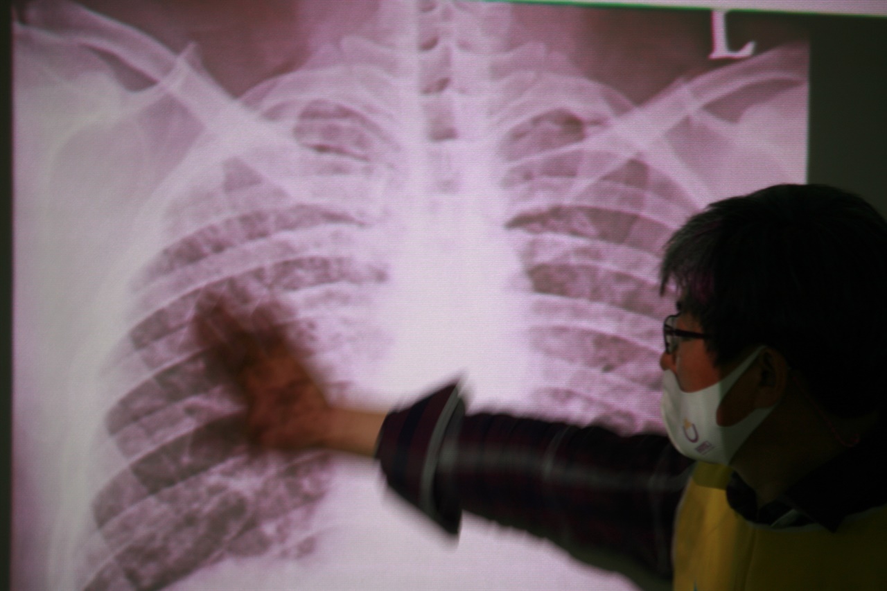 2016년 7월 당시 39세이던 김승환씨 엑스레이 폐사진에는 희끗희끗한 무언가가 많았다. 정상인의 경우 폐를 촬영하면 뼈와 살을 뺀 공기가 들어가는 부분은 검게 나오는데, 망가진 상태가 드러난 것이었다. 폐이식을 하기 직전에는 거의 새하얀 수준이었다. 