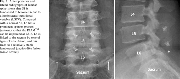 박종범 가톨릭대학교 의정부성모병원 교수의 논문에 실린 사진으로 L6은 Lumbar Spine 6, 즉 '요추 6번'을 의미한다.