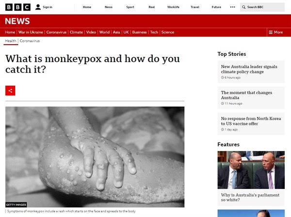원숭이두창 확산을 보도하는 영국 BBC 갈무리.