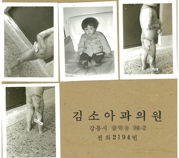 1979년 Mia씨가 발견된 뒤 강릉 지역의 한 의원에서 치료 과정에서 촬영하 사진이다. 해당 의원은 지금은 없어졌다.