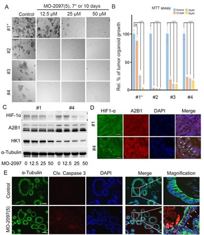 대장암 환자유래 암오가노이드에서 MO-2097의 HIF-1α표적 항암효능 확인 A~B. 4명의 환자의 대장암 유래 암 오가노이드에서 항암효능 확인 / C. 1번 및 4번 환자의 대장암 유래 암 오가노이드에서 MO-2097의 HIF1-α 억제를 웨스턴블롯에서 확인 / D. 실제 환자 조직에서 HIF-1α 발현 양 확인, HIF-1α 발현이 높은 환자인 4번 환자에서 MO-2097의 표적 정도가 높음을 확인 / E. 암 오가노이드의 형광 염색을 통하여 MO-2097에 의한 세포사멸 확인.