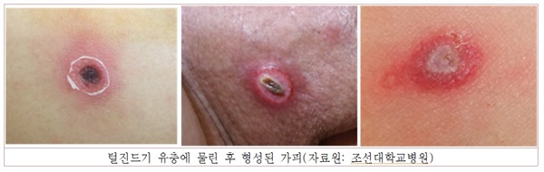  털진드기 유충에 물린 후 형성된 가피